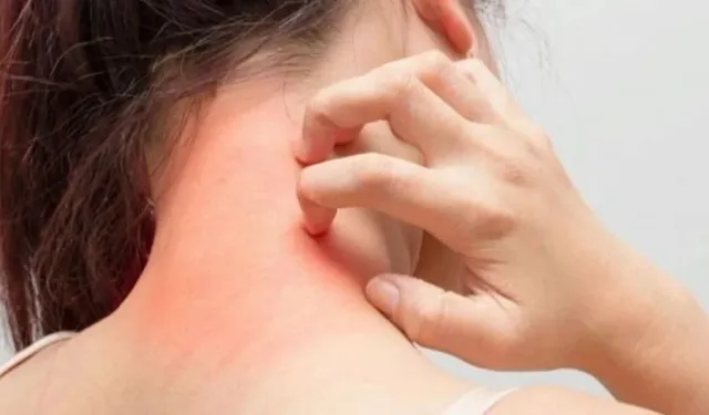 Gıda Alerjisine Dikkat! En Çok Alerji Yapan Besinler Açıklandı